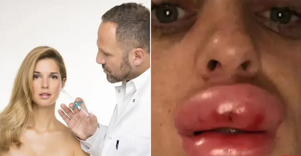 Ilegalno stavljaju silikone pa plaču, žele biti kao Seve i Maja: 'Dolaze mi spržene i s rupama'