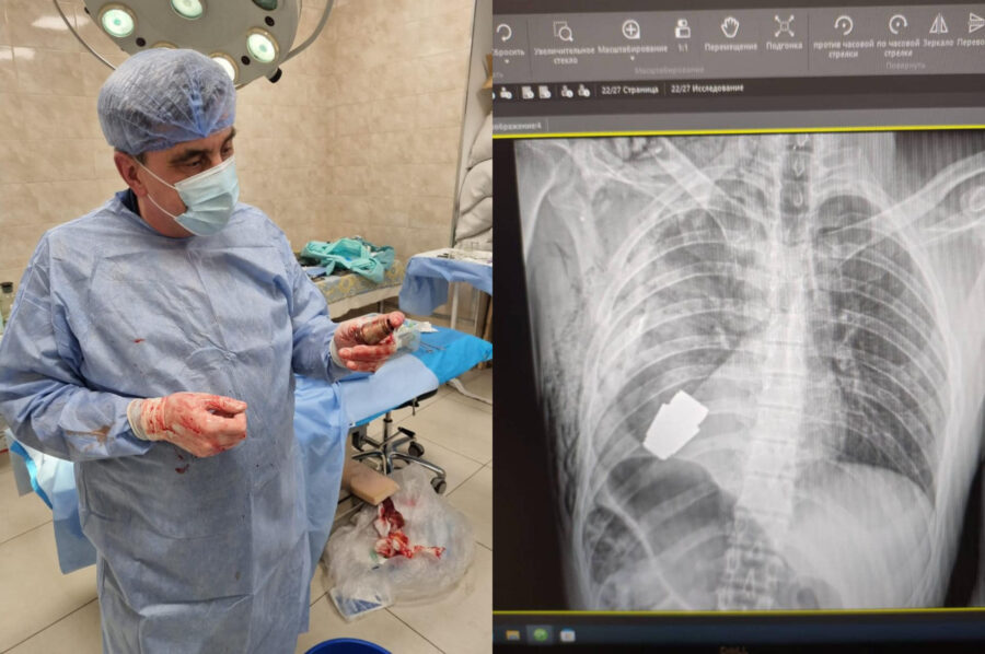 Čudo u Kijevu: Kirurzi iz tijela vojnika uklonili neeksplodiranu granatu