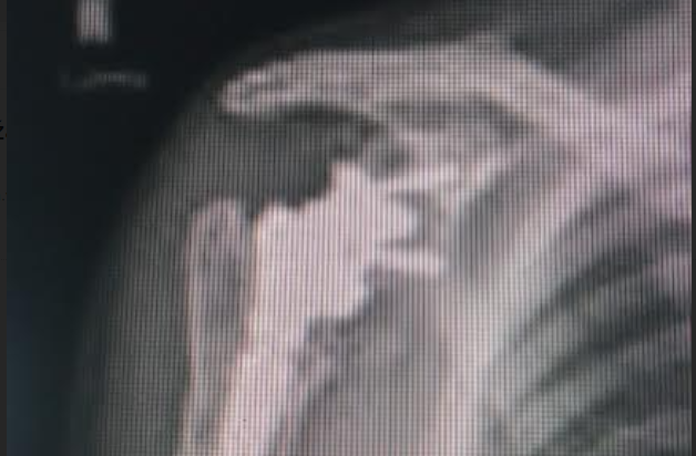 SRAMOTNO! OVO JE TIJELO HEROJA DOMOVINSKOG RATA! ‘Sam plaćam operacije, odbijena mi je rehabilitacija’