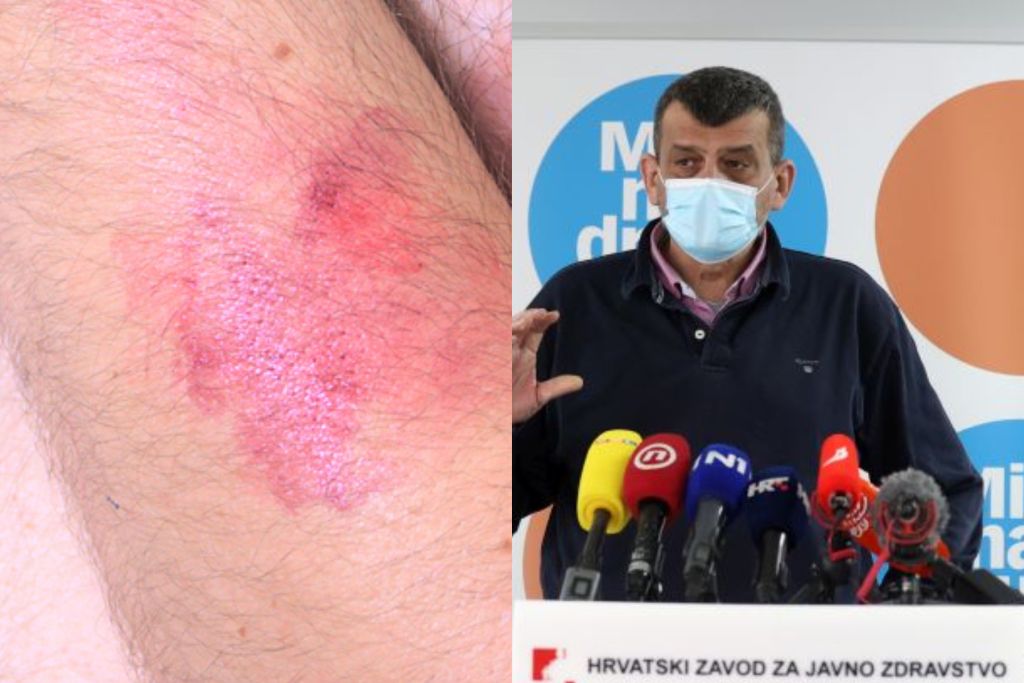 Epidemiolog o majmunskim boginjama: ‘Virus je koncentriran među muškarcima koji imaju spolne odnose s muškarcima‘