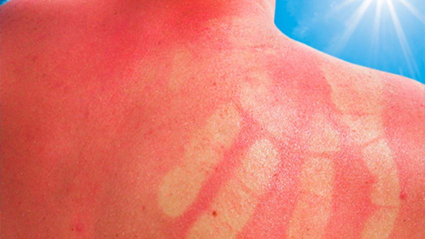 Kako ublažiti opekline od sunca i njegovati kožu nakon izlaganja