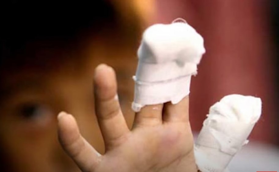 ‘U SEKUNDI JE POSTAO INVALID!’ Užas u Zagrebu, dječaku eksplodirala petarda u ruci: Spašavali su šaku, ali nisu uspjeli